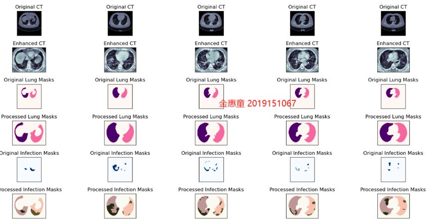 【计算机视觉】新冠肺炎COVID-19 CT影片阳性检测，感染区域分割，肺部分割，智慧医疗实践，医疗影像处理示例