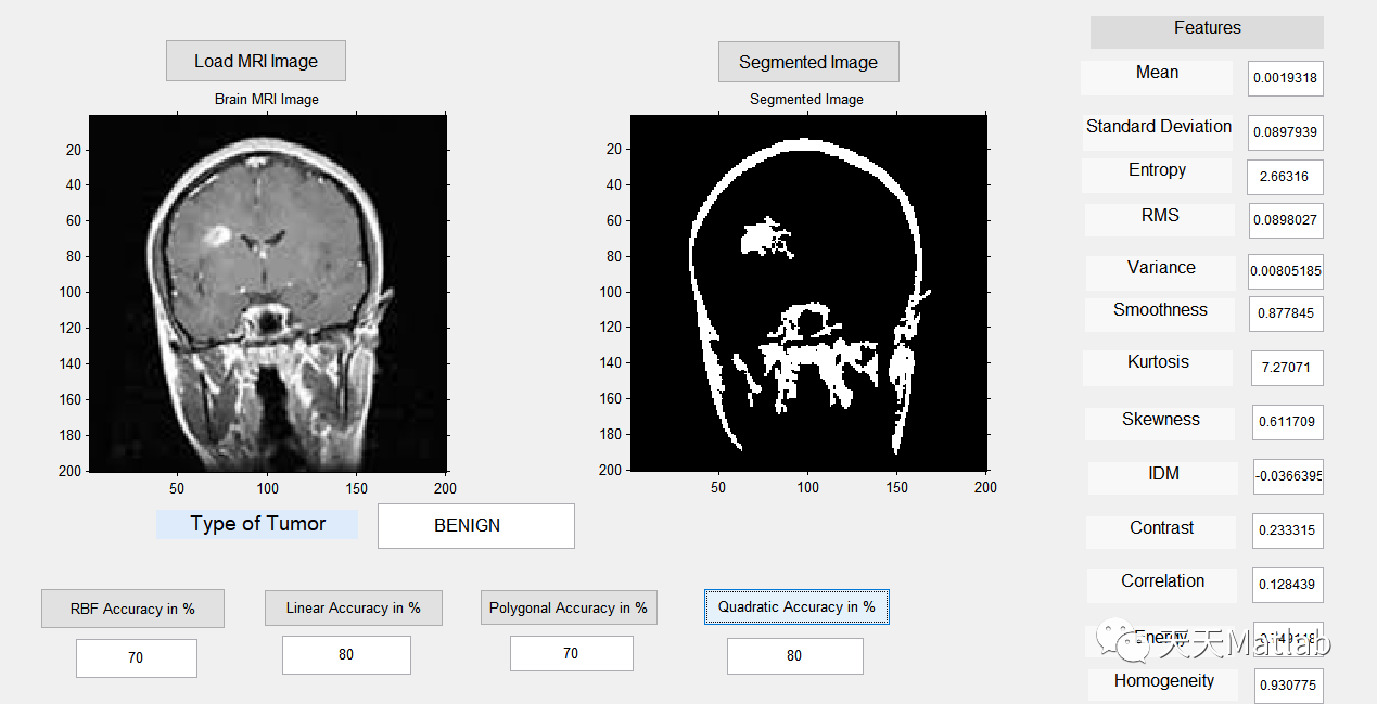 【图像检测】基于多种特征结合支持向量机实现脑 MRI 肿瘤检测和分类附Matlab 代码
